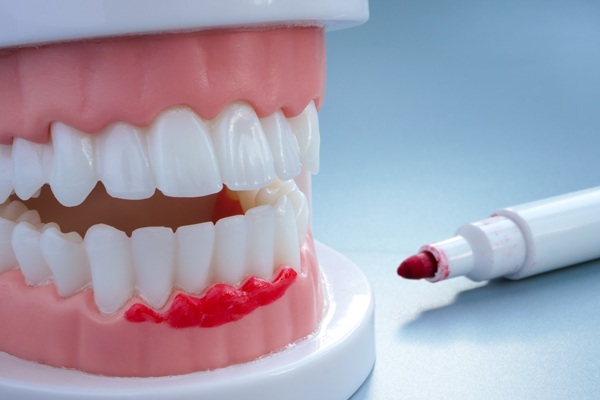 Can Gum Disease Treatment Restore My Oral Health?