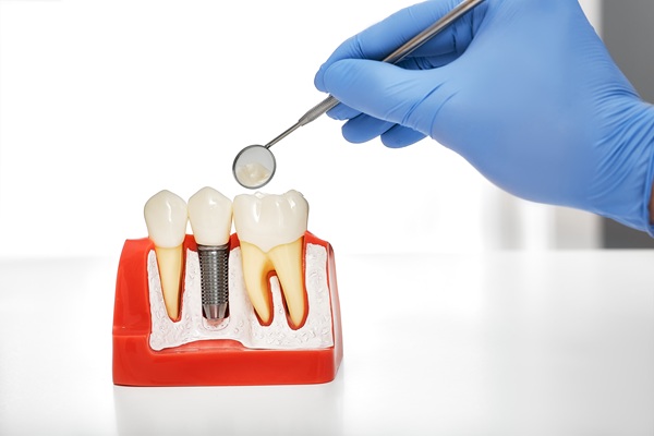 Implant Crowns: The Key To Restoring Missing Teeth