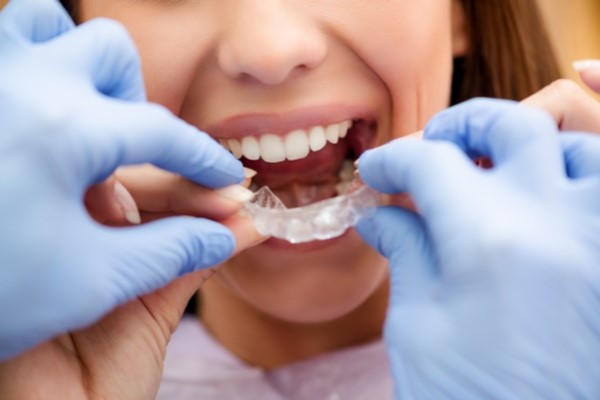 How Clear Aligners Straighten Teeth Without The Hassle Of Braces